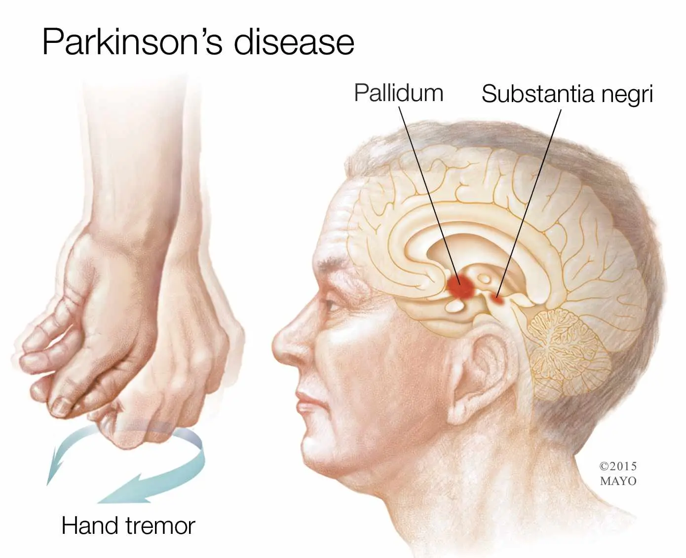 Japan odobrio prvu terapiju na bazi matičnih ćelija za Parkinsonovu bolest